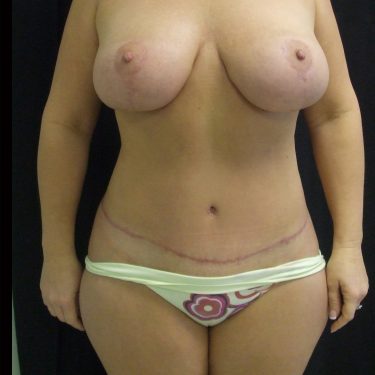 Tummy Tuck After Patient 6