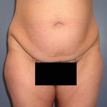 Tummy Tuck Before Patient 5