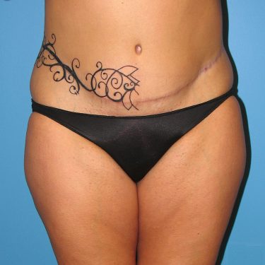 Tummy Tuck After Patient 5