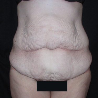 Tummy Tuck Before Patient 22