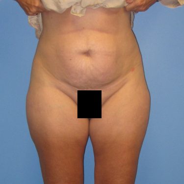 Tummy Tuck Before Patient 4