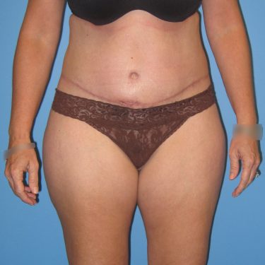 Tummy Tuck After Patient 4