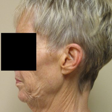 Facelift Before Patient 2