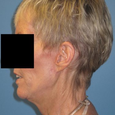 Facelift After Patient 2