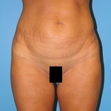 Tummy Tuck Before Patient 27