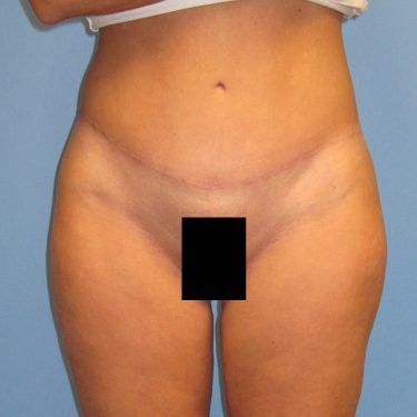 Tummy Tuck After Patient 27
