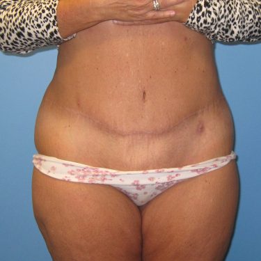 Tummy Tuck After Patient 1