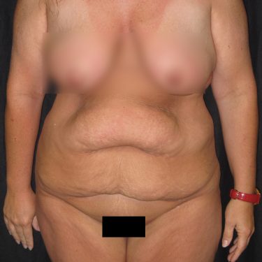 Tummy Tuck Before Patient 21