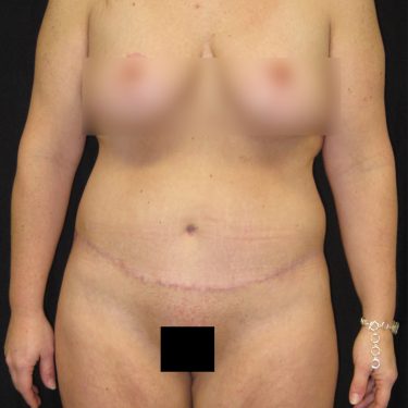 Tummy Tuck After Patient 21