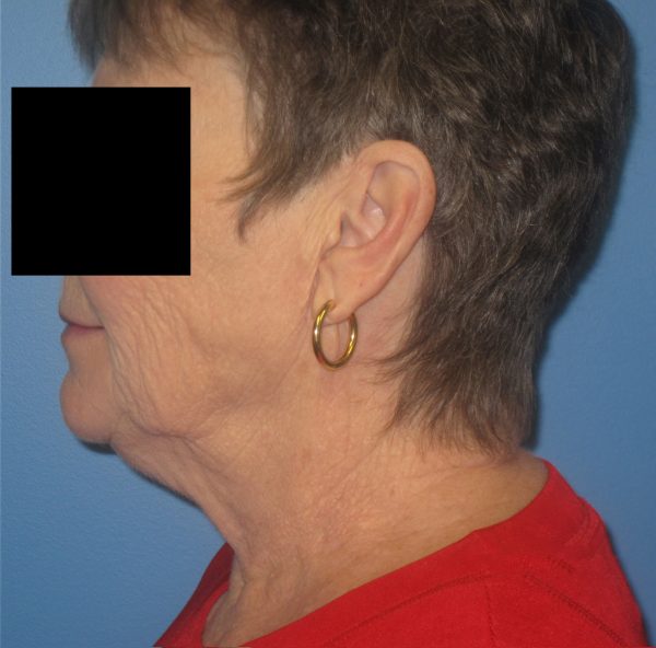 Facelift Before Patient 1