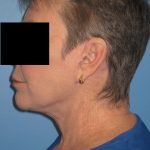 Facelift After Patient Thumbnail 1