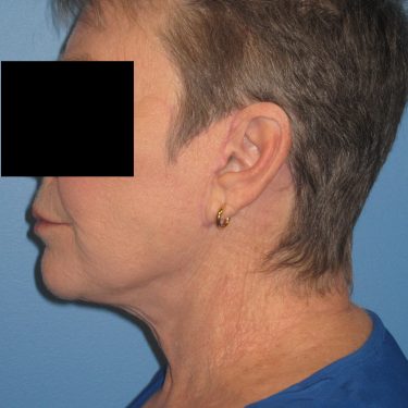 Facelift After Patient 1