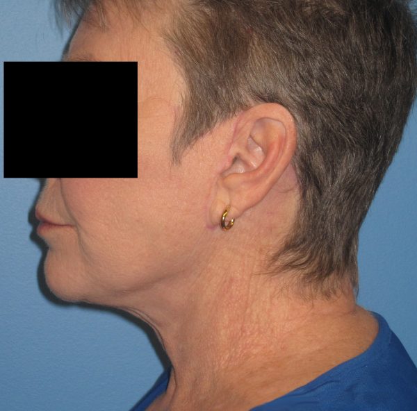 Facelift After Patient 1