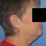 Facelift Before Patient Thumbnail 2