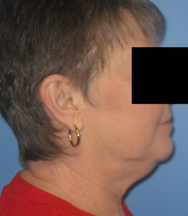 Facelift Before Patient 2