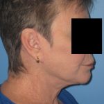 Facelift After Patient Thumbnail 2