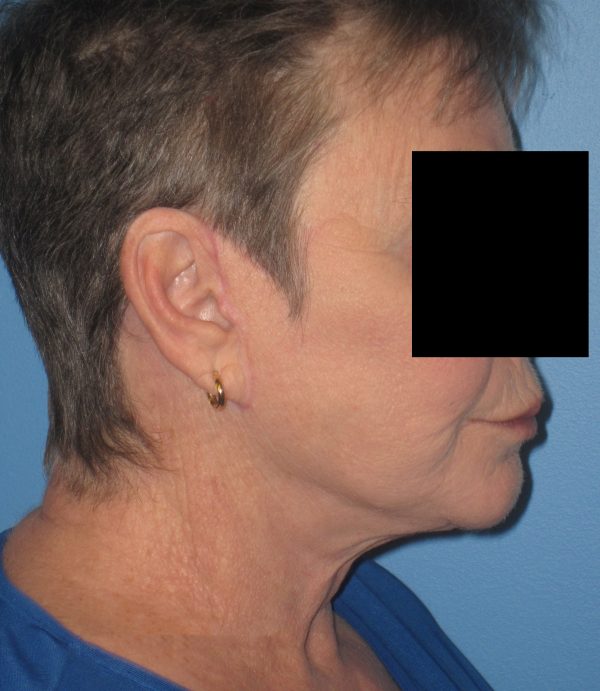 Facelift After Patient 2