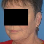 Facelift Before Patient Thumbnail 3