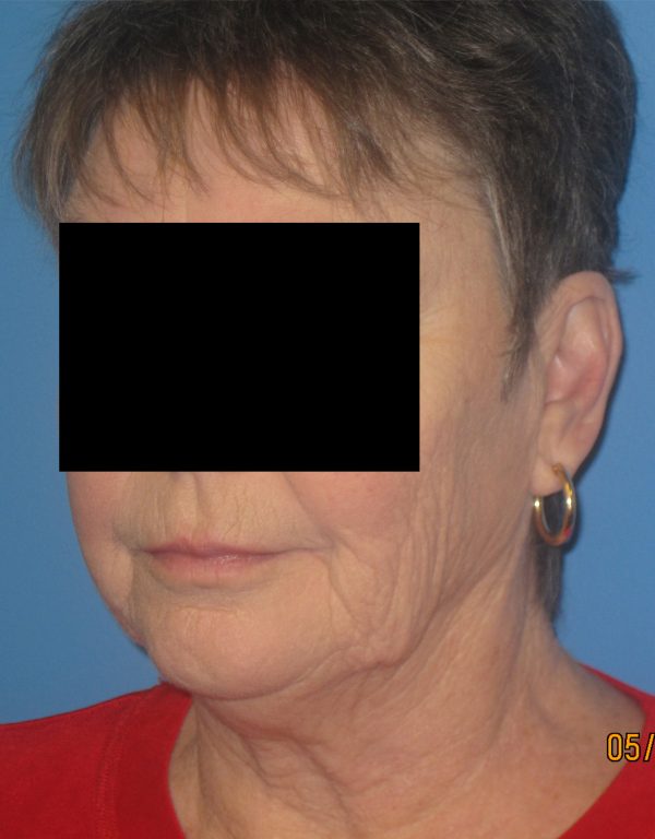 Facelift Before Patient 3