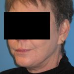 Facelift After Patient Thumbnail 3