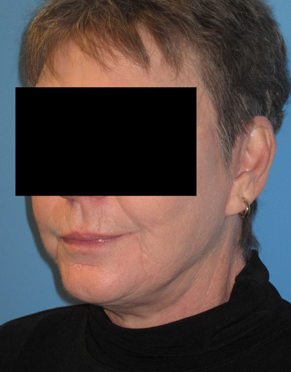 Facelift After Patient 3