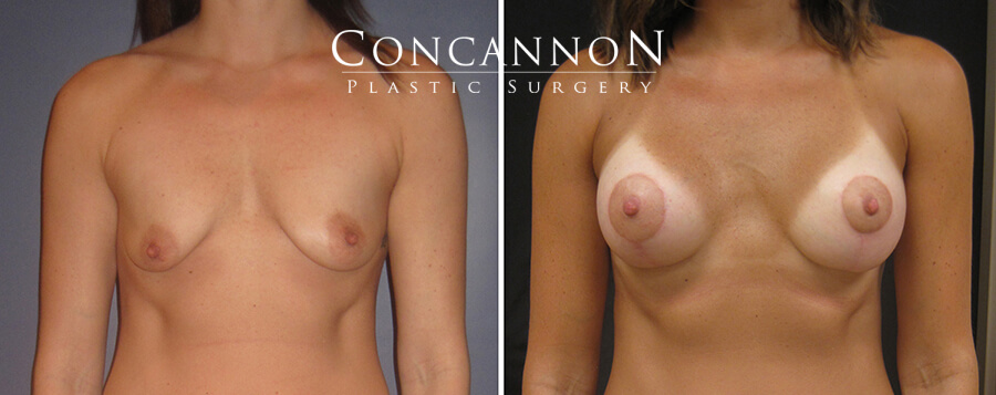 Dr. Concannon patient: Before and after breast augmentation. Results may vary