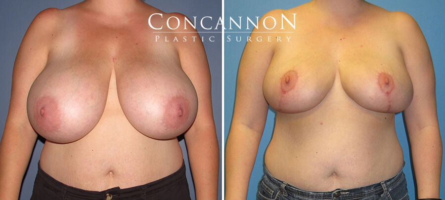 Breast Reduction Actual Patient