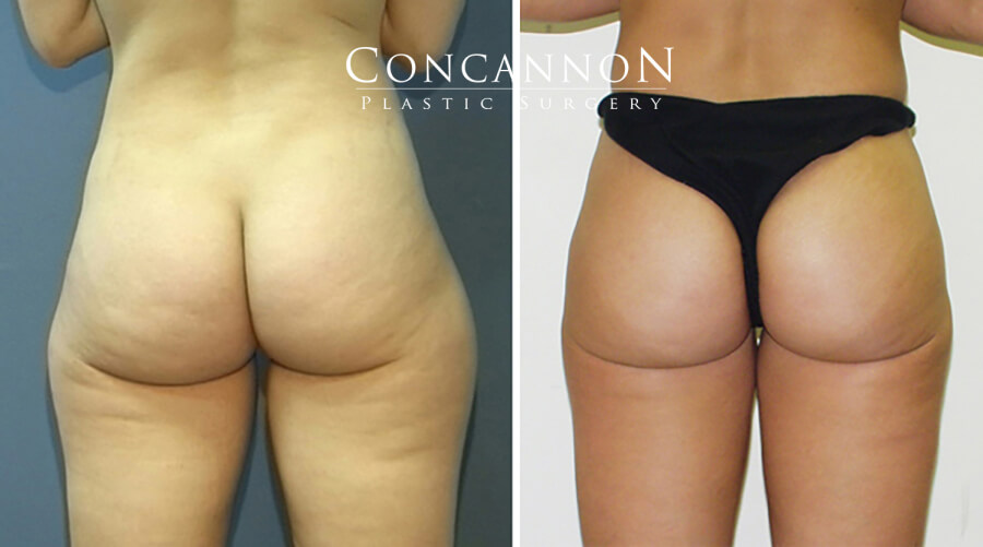 Before and after Liposuction