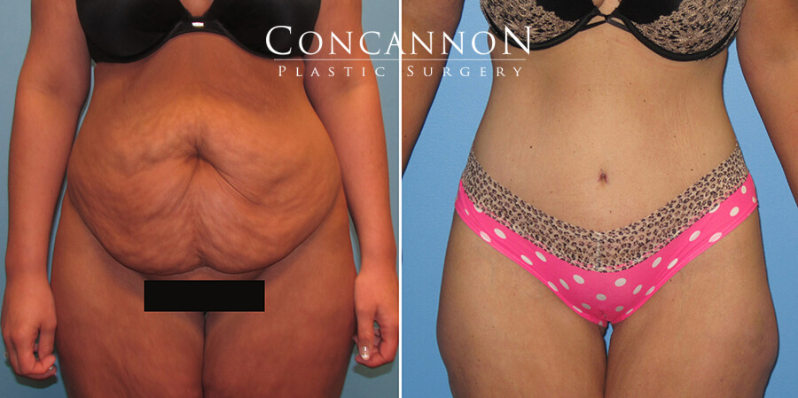 Before and After Tummy Tuck Surgery