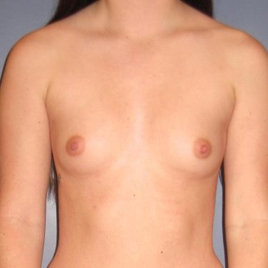Breast Augmentation Before Patient 17