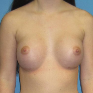 Breast Augmentation After Patient 17