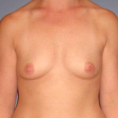 Breast Augmentation Before Patient 22