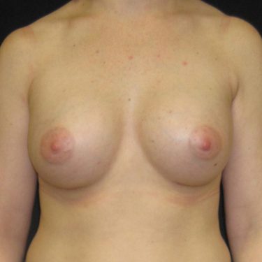 Breast Augmentation After Patient 22