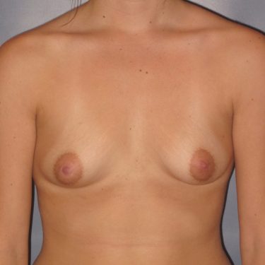 Breast Augmentation Before Patient 20