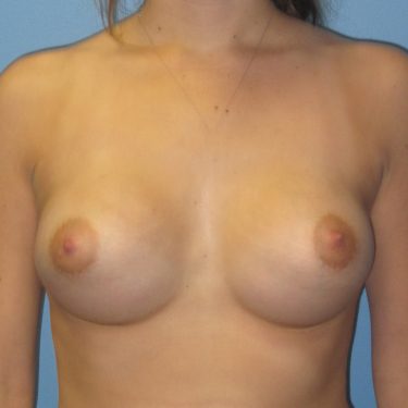 Breast Augmentation After Patient 20