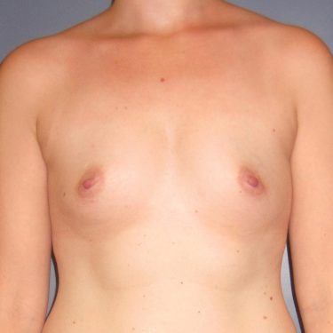 Breast Augmentation Before Patient 19