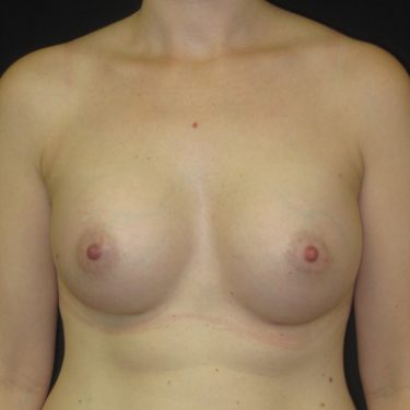 Breast Augmentation After Patient 19