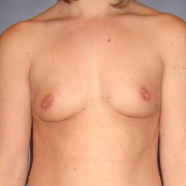 Breast Augmentation Before Patient 18