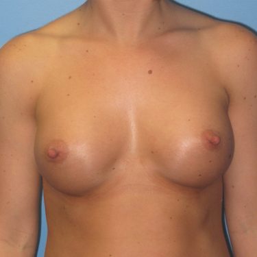 Breast Augmentation After Patient 18